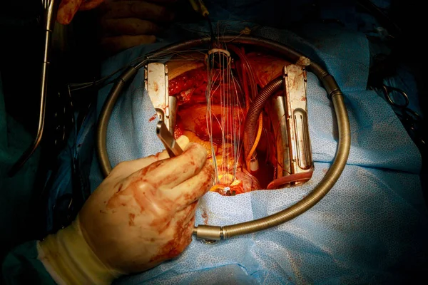 Procedimento Cardíaco Aberto Cirurgia Substituição Mecânica Válvula Implante Aórtico — Fotografia de Stock