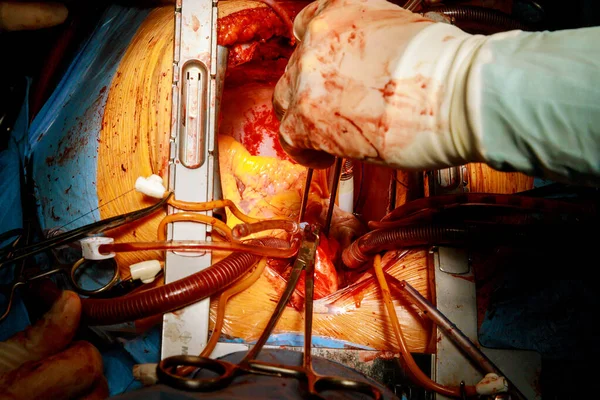 Surgery minimally invasive surgery patient during a heart surgery at a hospital in the surgical operating room
