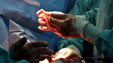 Cerrah elleri ameliyat sırasında açık kalp ameliyatı yapıyor.