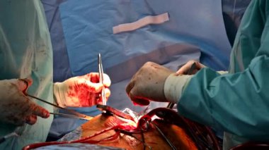 Hastanedeki bir grup cerrah açık kalp ameliyatı geçirdi.