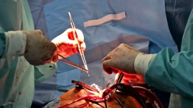 Ameliyathanedeki bir kalp ameliyatı sırasında hasta.