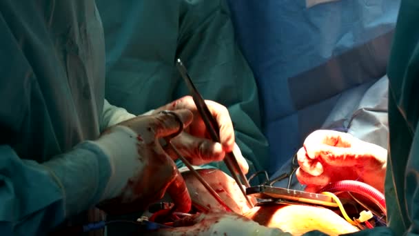 Team van chirurgen in ziekenhuis open hart chirurgie — Stockvideo