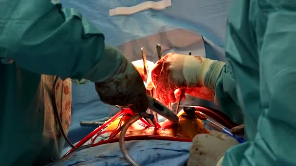 Surgeon doctor close up hands of open heart of surgeons — Stock Video