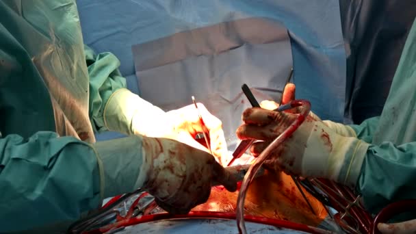 Verschillende chirurgische hulpmiddelen buizen verbonden met het hart close-up open hartchirurgie — Stockvideo
