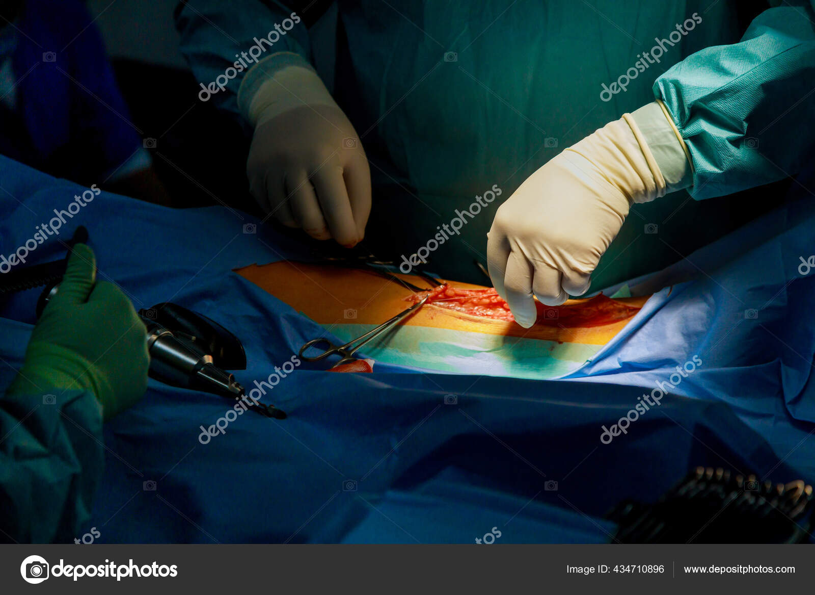 Chirurgien Fait Une Incision Profonde Aide Crayon Scalpel Électrique Pour — Photo