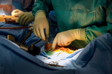 Cerrah, bacak ameliyatında kanamayı durdurmak için neşter kullanarak derin bir kesik atar.