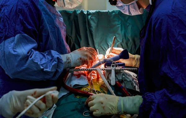 Patient Lors Une Chirurgie Cardiaque Dans Hôpital Salle Opération Chirurgicale — Photo