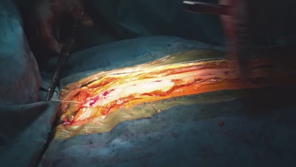 En läkares händer syr ihop ett sår efter en operation på sjukhuset. — Stockvideo