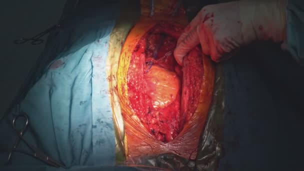 Göğüs ameliyatı sırasında göğsü açık bir şekilde insan kalbi atıyor. — Stok video