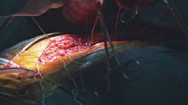 Cirujanos suturando al paciente enfermo después de realizar una cirugía seria. — Vídeo de stock