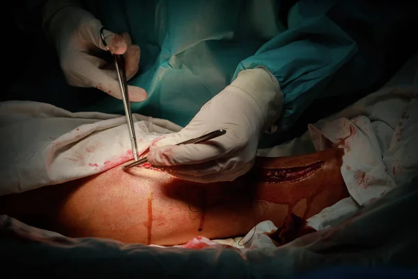 Sebész Mély Varrást Végez Beteg Lábán Hogy Elállítsa Vérzést Műtét — Stock Fotó