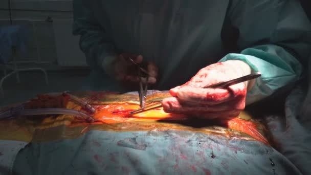 Операційна кімната в команді лікарів носить синє пальто виконує операцію на серці лікарні . — стокове відео
