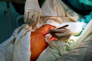 Cerrahlarla ayak ameliyatı. Ameliyat odasında hastanın bacağı üzerinde çalışıyoruz..