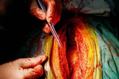 Ameliyathanede tıbbi malzemeler kullanılarak travmanın ameliyat işlemleri