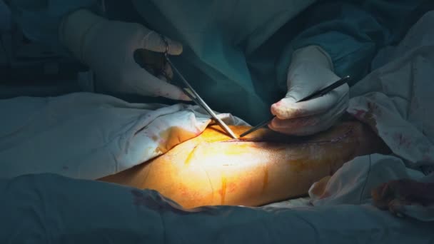 Seams with self-absorbable threads with surgeon leg during surgery with neat stitches doctor sewing on wound in operating room — Stock video