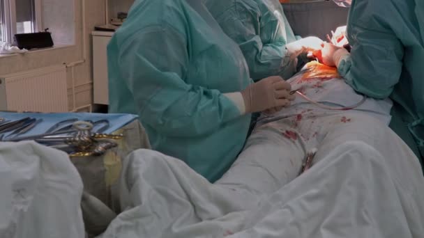 Coronaire bypass transplantatie voor open hart chirurgie — Stockvideo