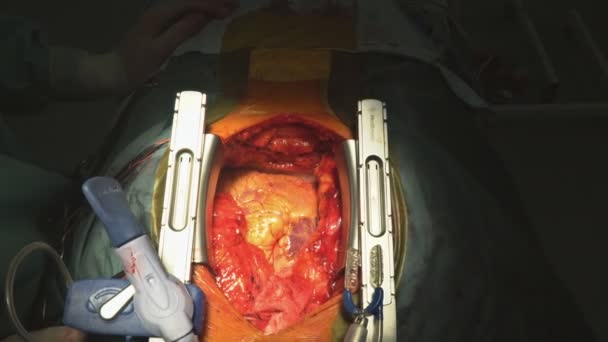 Coronaire bypass transplantatie voor open hart chirurgie — Stockvideo