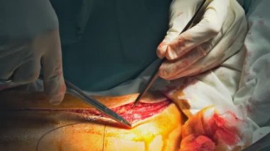 Ameliyat sırasında cerrah bacağı. Düzgün dikişler atılmış. Doktor, hastanedeki ameliyathanede dikiş dikiyor.