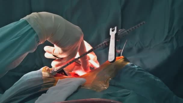 患者の手術の上に立つ外科医患者の手術を行う医療従事者 — ストック動画