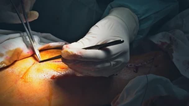 Operating room with doctor suturing the patients leg after surgery — Stock Video