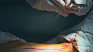 Ameliyat sırasında bacağa dikiş atıldı.