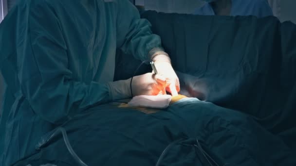 Ασθενής χειρουργικής επέμβασης κατά τη διάρκεια του χειρουργείου του για την έναρξη της χειρουργικής επέμβασης — Αρχείο Βίντεο