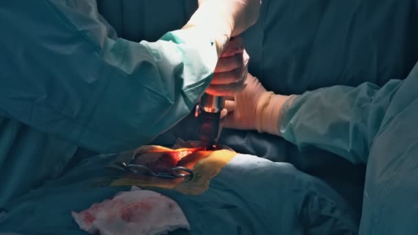 Ομάδα χειρουργών λειτουργούν στο χειρουργείο με χειρουργική επέμβαση εκτελέσει σε χειρουργικό εξοπλισμό — Αρχείο Βίντεο