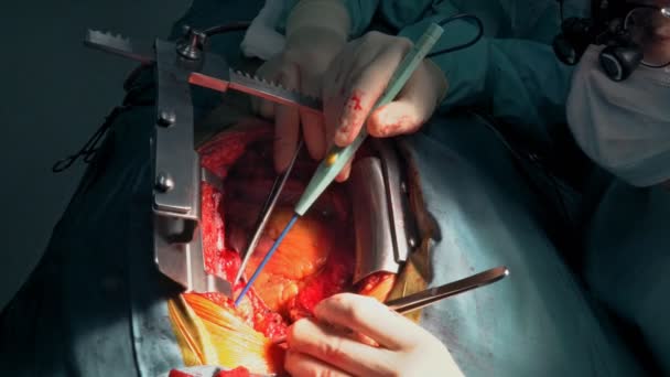 Пациент во время операции на сердце в больнице в операционной — стоковое видео