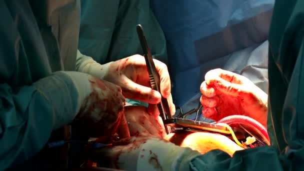 Hastanedeki bir grup cerrah açık kalp ameliyatı geçirdi. — Stok video