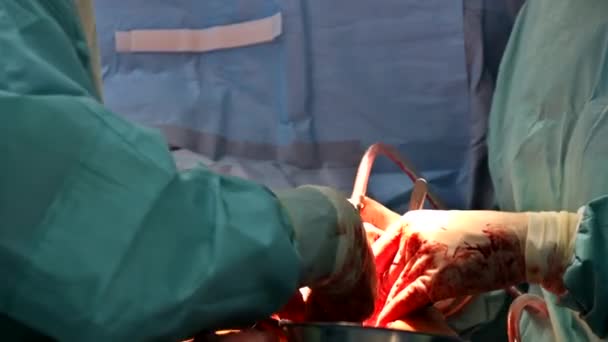 Surgeon doctor close up hands of open heart of surgeons — Stock Video