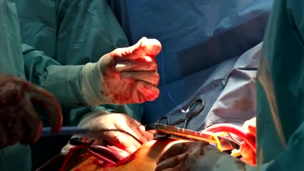 Surgeon hands are operating during the surgery with open heart — Stock Video