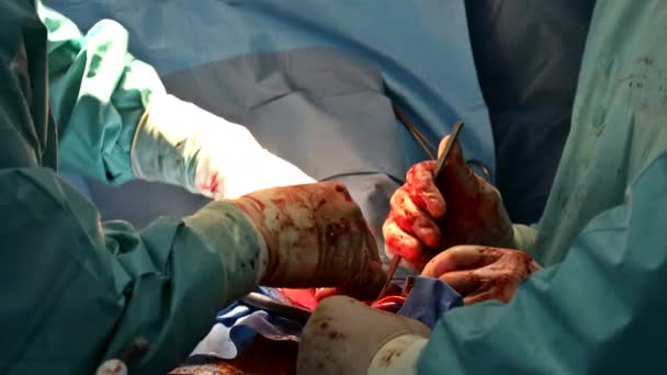 Patient during a heart surgery at a hospital in operating room — Stock Video