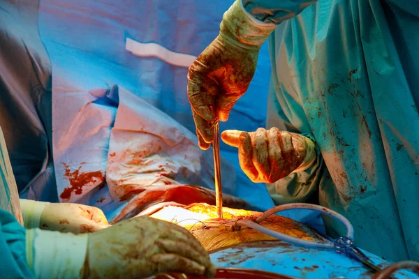 Mãos Cirurgião Médico Estão Costurando Uma Ferida Após Uma Operação — Fotografia de Stock