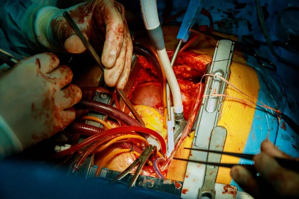 Operación Cirugía Proceso Trauma Utilizando Equipo Médico Quirófano — Foto de Stock