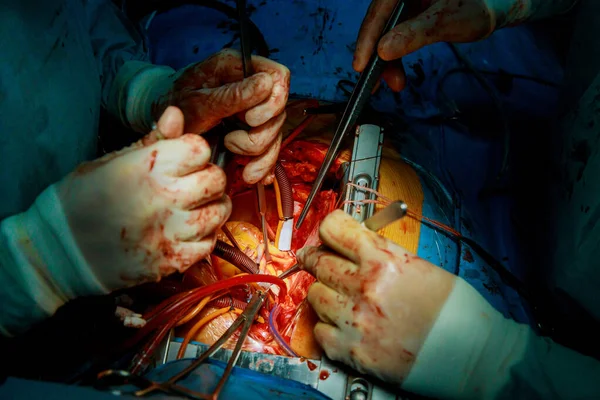 Cirugia Pulmonar Cirujano Equipo Realizan Cirugía Torácica Cáncer Pulmón — Foto de Stock