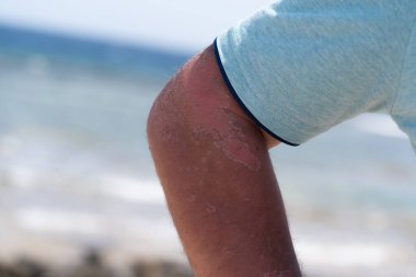 Güneşten yanmış bir el.