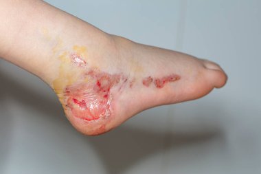 Bir kaza sonucu çocuğun ayağı üst deri tabakasından mahrum bırakıldı.