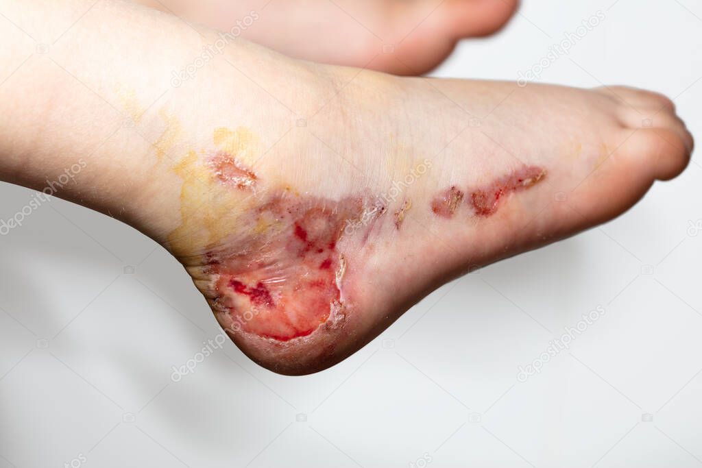 child's foot deprived of the top layer of the epidermis as a result of an accident