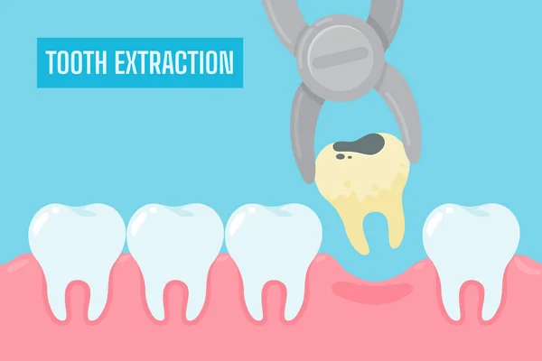 Extração Dentes Desenhos Animados Dentes Amarelos Com Tártaro Placa Removida —  Vetores de Stock