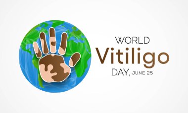 Dünya Vitiligo Günü her yıl 25 Haziran 'da kutlanır ve soluk beyaz yamaların ciltte geliştiği uzun vadeli bir durumdur. Derideki pigmentler olan melanin eksikliğinden kaynaklanıyor..