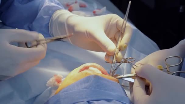 Chirurg odstraňuje bukální tuk. Odstranění bishova hrudku. Plastická chirurgie na klinice — Stock video