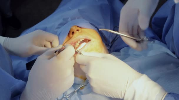Odstranění bukálního tuku. Odstranění bishova hrudku. Plastická chirurgie na klinice — Stock video