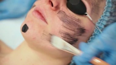 Dermatolog yüzüne siyah maske sürüyor lazer fotorejuvenasyon ve karbon soyma için. Dermatoloji ve kozmetoloji. Cerrahi lazer kullanarak..
