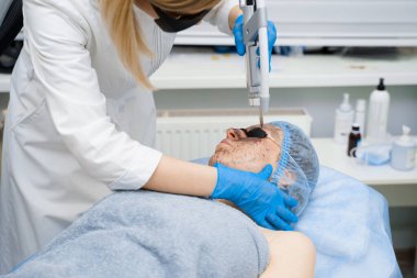 Kadınlar için lazer fotoregenasyon ve karbon soyma. Siyah yüz maskesi. Dermatoloji ve kozmetoloji. Cerrahi lazer kullanarak..