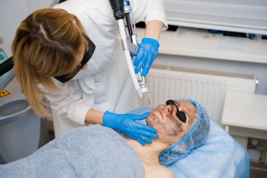 Kadınlar için lazer fotoregenasyon ve karbon soyma. Siyah yüz maskesi. Dermatoloji ve kozmetoloji. Cerrahi lazer kullanarak..