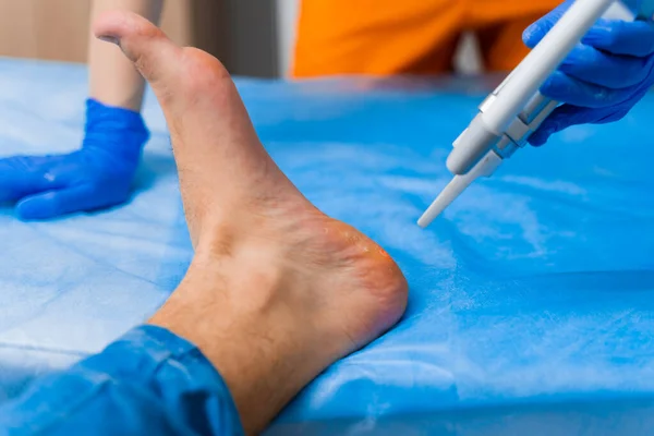 Eliminación Por Láser Las Verrugas Pie Cirugía Dermatológica Médica Clínica — Foto de Stock