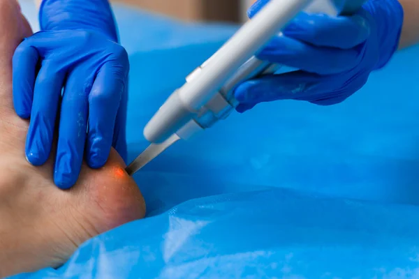 Ayağındaki siğillerin lazerle çıkarılması. Klinikte tıbbi dermatolojik ameliyat.