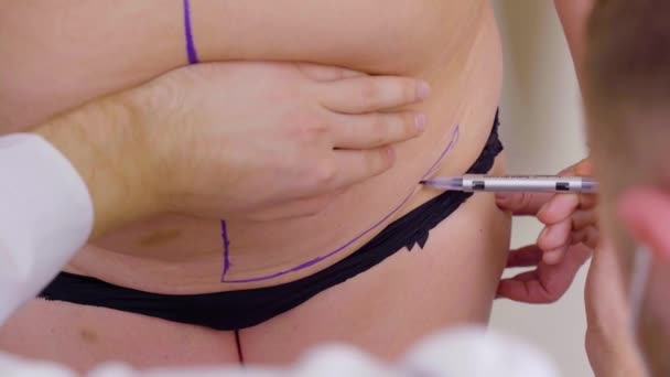 Abdominoplasty markup before plastic operation to reduce the abdomen and remove cellulite. Correcting body shape. Surgeon does liposuction for patient in medical clinic — Stock Video