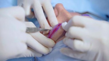 Tıbbi klinikte yüz bölgesinin değiştirilmesi için Blepharoplasty estetik ameliyatı. İki doktor kadınlar için estetik ameliyat yapıyor. Cerrah göz kapağına dikiş atar.