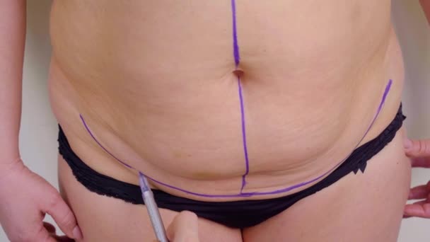 Marcação Abdominoplastia Antes Operação Plástica Para Reduzir Abdômen Remover Celulite — Vídeo de Stock